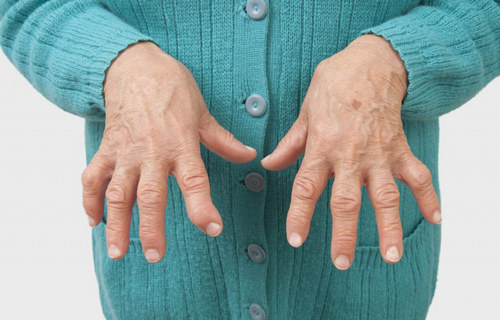 ژنتیک، عامل مهم و موثر در بروز بیماری آرتریت روماتوئید